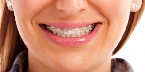 1391094-Na-darmowy-aparat-ortodontyczny-moga-liczyc-tylko-dzieci-do-12-roku-zycia-potem__c_10_31_721_429